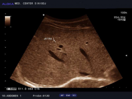 Ultrazvok trebuha - normalen izvid jeter